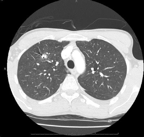 Ct Scan Of The Chest Interpretation Multiple Metallic Foreign Bodies