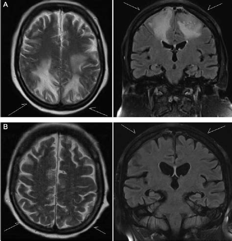 A Magnetic Resonance Imaging Mri Transversal Section T2 And