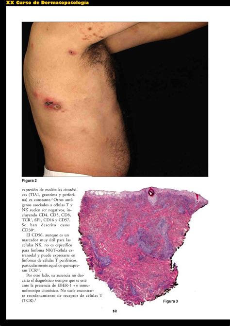 Xx Curso De DermatopatologÍa By Grupo Español Dermatopatología Issuu