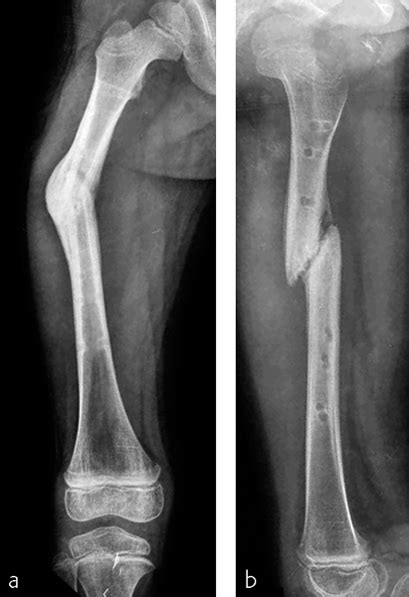 Minimally Invasive Plate Osteosynthesis After Osteotomy For Deformity