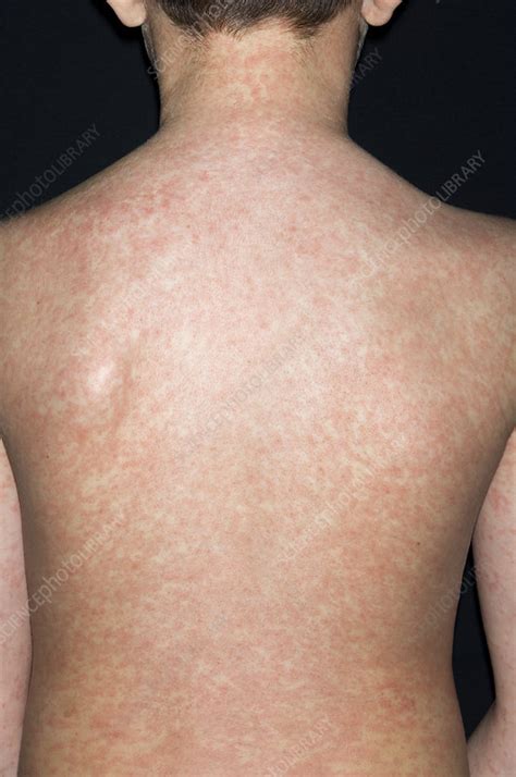 Measles Rash Stock Image M2100365 Science Photo Library
