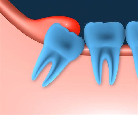 Impacted Wisdom Teeth Symptoms Nhs