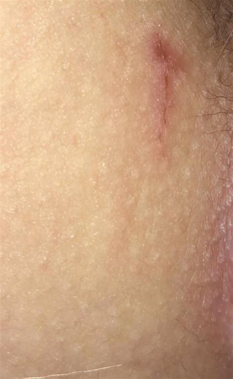 Hsv This Is Right Above My Anus Showed Up Yesterday And It Was Oozing