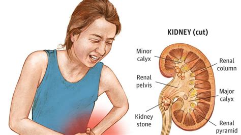 Kidney Stones