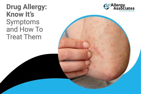 Drug Allergy Know Its Symptoms And How To Treat Them