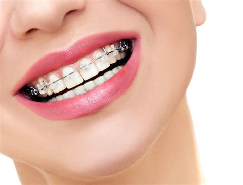 What Is The Best Age To Start Orthodontics