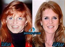 Sarah Ferguson Plastic Surgery Before and After - Plastic Surgery Facts