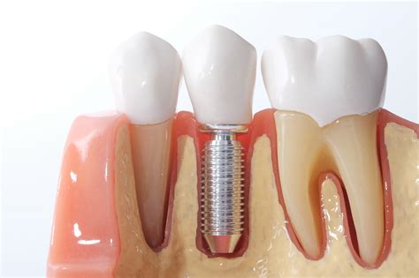 7 Factors To Consider Before Getting Dental Implants