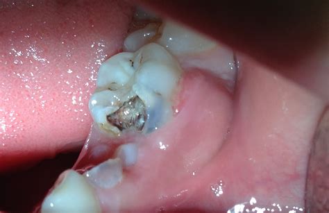 Case 5 Pediatric Dentistry What Is A Dental Abscess What Causes