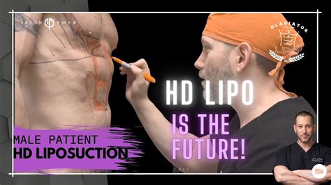 Male Gladiator 360 Hd Lipo And Tummy Tuck The Future Is With Hd