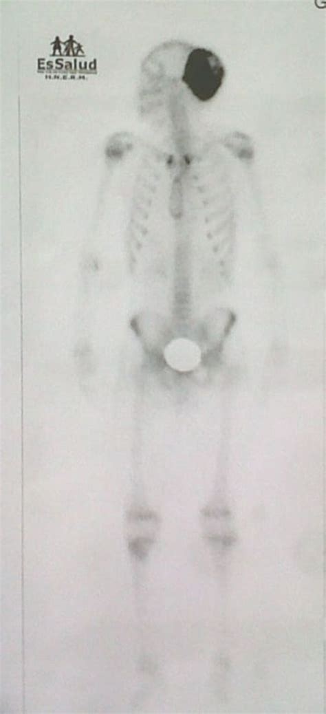Primary Osteosarcoma Of The Skull In Teenager Bmj Case Reports
