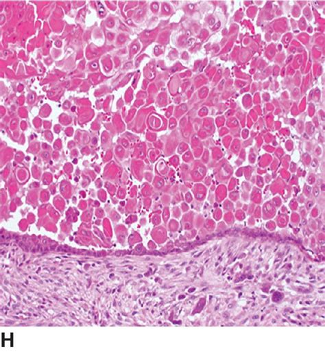 Epithelial And Melanocytic Tumors Of The Skin Veterian Key