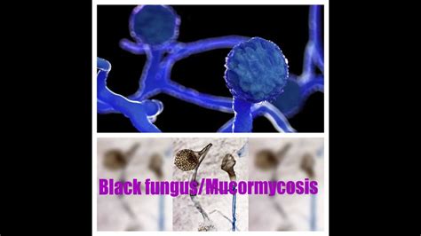 Mucormycosisblack Fungus Youtube