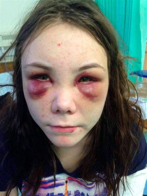 Teen Torture Victim Speaks Out About Ordeal Daily Star