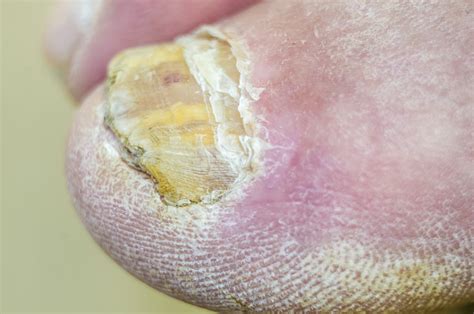 Fungal Nail Infection How Does It Occur