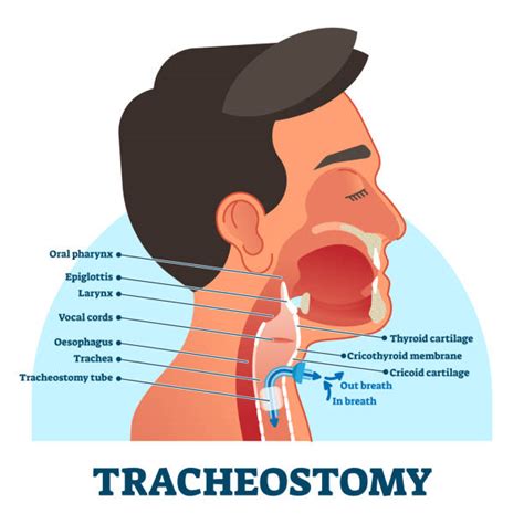 Tracheostomy Pic Illustrations Royalty Free Vector Graphics And Clip Art