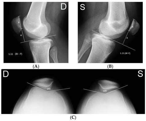 Medicina Free Full Text First Time Acute Lateral Patellar