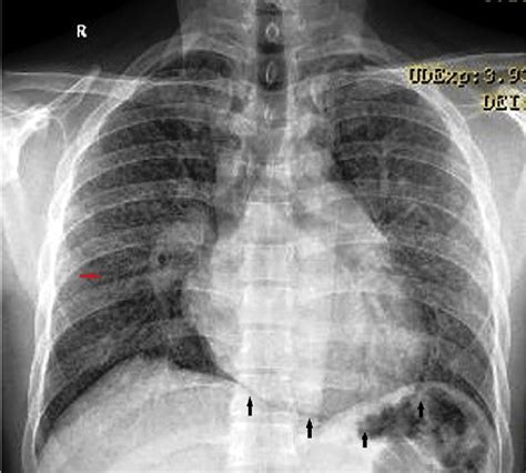 E Erect Chest X Ray Pa View Demonstrating The Continuous Diaphragm