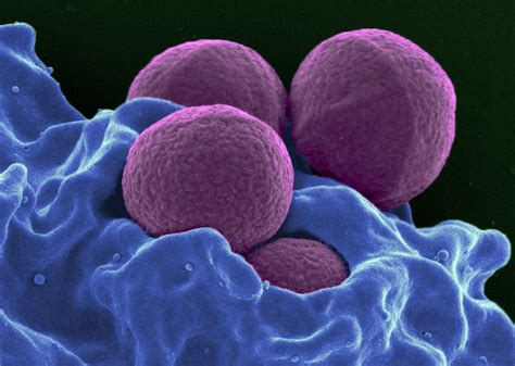 Very young children and elderly. Common antimicrobials help patients recover from MRSA ...