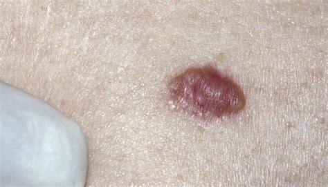 Skin Cancer Rash On Arm