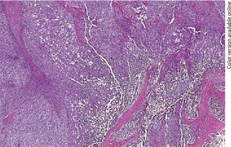 Figure 2 From Spindle Epithelial Tumor With Thymus Like Differentiation