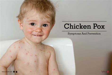 Chicken Pox Symptoms And Prevention By Dr Pankaj Tiwary Lybrate Hot