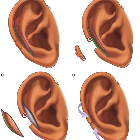 Elevation Of The Retroauricular Flap And The Dissection Plane Between