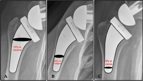 Inclination Of Humeral Components Ac A Neutral Stem Inclination