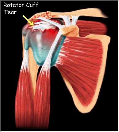A thorough history and physical exam will nearly always lead to a correct diagnosis. Rotator cuff injury. Causes, symptoms, treatment Rotator ...