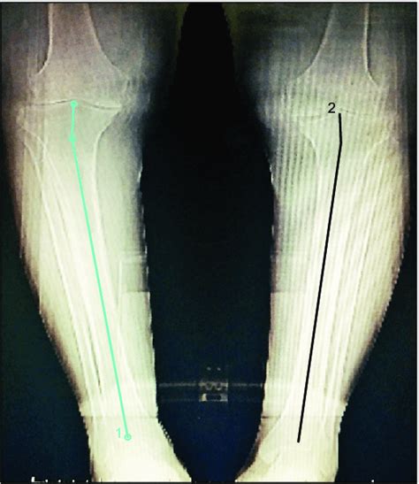 Preoperative Scanogram Showing Bilateral Osteoarthritis Of The Knees