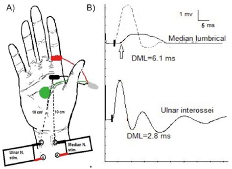 Clinical And Electrophysiological Evaluation Of Carpal Tunnel Syndrome