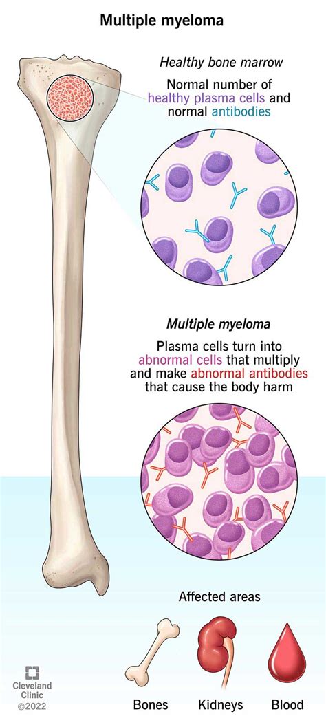 Multiple Myeloma Symptoms What It Is Prognosis And Treatment