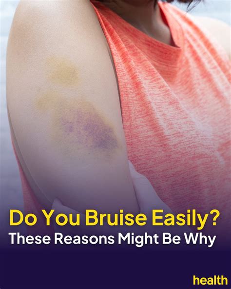 Do You Bruise Easily These Reasons Might Be Why By Health Tips And