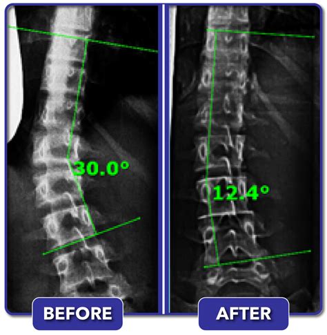 Scoliosis Before And After Treatment Results Scoliosis Care Centers