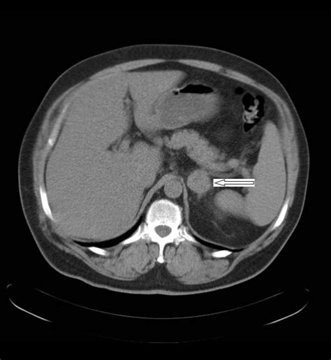 Ct Scan Showing An Adrenal Metastasis To The Contralateral