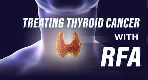 Treating Thyroid Cancer With Rfa And No Surgery 🛑