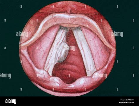 Diagram Vocal Cords With Sessile Polyp Stock Photo 1684812 Alamy