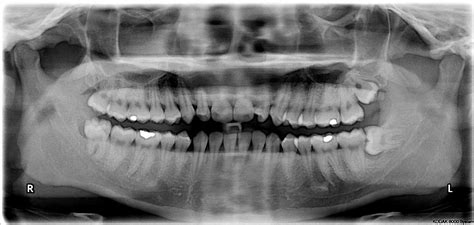 Dental Extractions And Wisdom Teeth Seven Hills Dentist Capstone Dental
