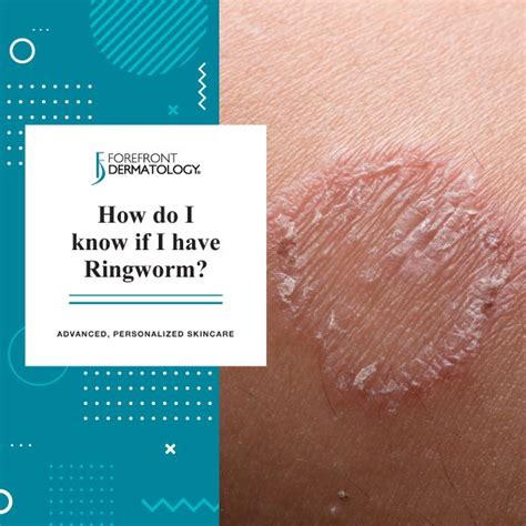 How Do I Know If I Have Ringworm Forefront Dermatology