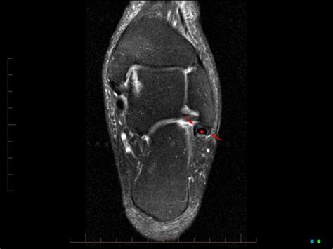 Atypical Scan Angles In Musculoskeletal Mri Radsource