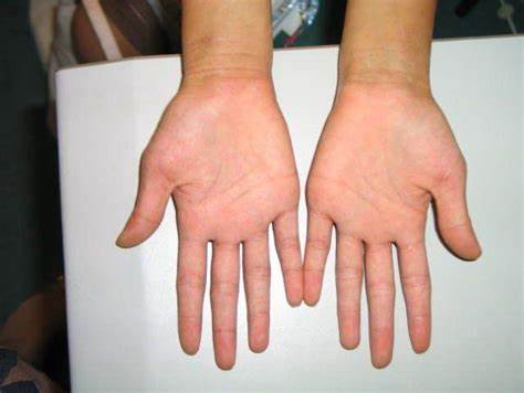 Дерматит симптомы диета Дерматит атипичный у детей и взрослых: симптомы, причины, лечение и Дерматит атипичный у детей и взрослых: симптомы, причины, лечение и Дерматит симптомы диета