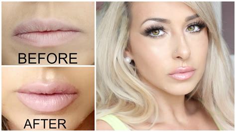 Getting Lip Injections Juvederm Lip Injections Before And After