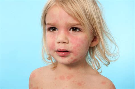 An allergic reaction occurs when the body's immune system overreacts to an allergen, in this generally a food allergy is identified by signs and symptoms. Food Allergy or Sensitivity