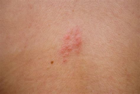 Headache Rash And High Temperature It Could Be Painful Virus Shingles