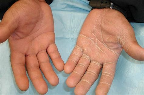 An Itchy Rash On A Mans Hand Clinical Advisor