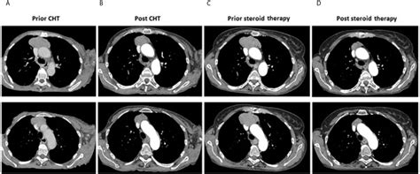 Frontiers Remission Of Thymoma On Steroid Therapy In A Patient With