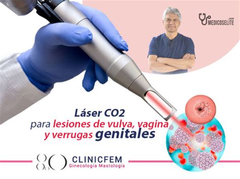 Tratamiento Papiloma Quito Con Láser Vph Efectivo Clinicfem