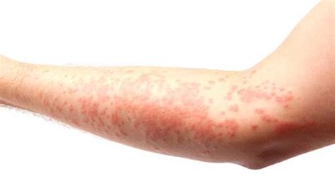 Allergy Skin Rash Dorothee Padraig South West Skin Health Care