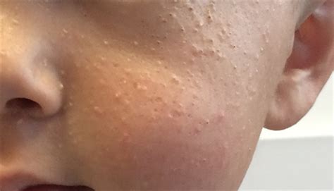 White Papules And Follicular Abnormalities On A Toddlers Face