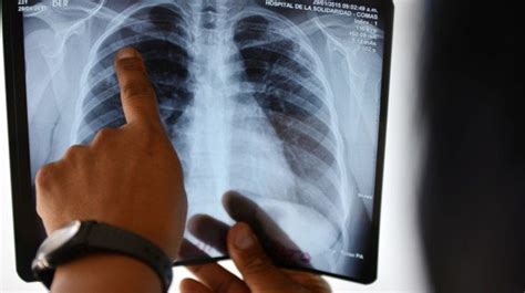 Debunked 5 Common Myths About Tuberculosis Huffpost Null